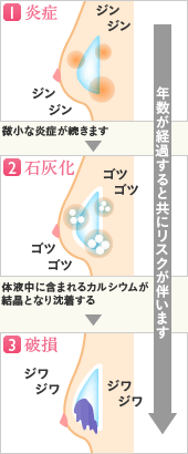 炎症、石灰化、破損と、年数が上回るとともにリスクがともないます