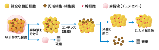 吸引された脂肪から麻酔液と注入する脂肪を分け、その後、半分から幹細胞を取り出します