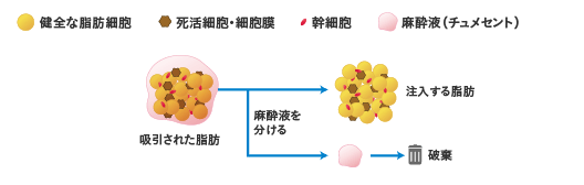 吸引された脂肪から麻酔液と注入する脂肪を分けます
