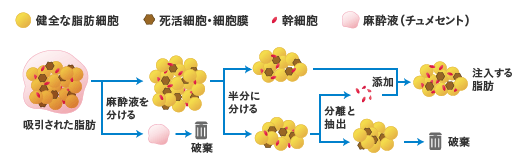 吸引された脂肪から麻酔液と注入する脂肪を分け、その後、半分から幹細胞を取り出します