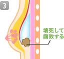 壊死して腐敗する