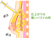 仕上がりの悪いバストの形