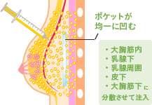 ポケットが均一に凹む