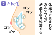 2.石灰化／体液中に含まれるカルシウムが結晶となり沈着する