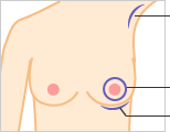 わき（腋窩）切開（傷跡が目立たない）／乳輪切開（傷跡が目立つ）／乳房下溝切開（傷跡が目立つ）