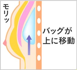 胸に力を入れるとバッグが上に移動して不自然に盛り上がる