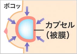 皮膜が必要以上に強く取り囲み。厚くなりバッグを強く締め付ける