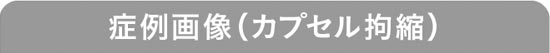 症例画像 （カプセル拘縮）