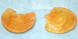 石灰化が起き、中の液体は無い状態。CMCバッグは、挿入期間の経過に連れて青色→緑色→黄色と変色するのが特徴