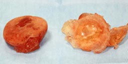 皮膜が厚く癒着、石灰化、変形し破損している