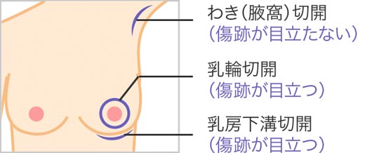 ケロイド体質の方