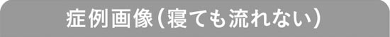 症例画像（寝ても流れない）