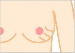バッグの表面がしわになってバストが波打ったように見える