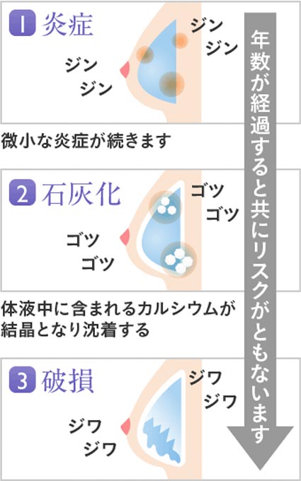 年数が経過すると共にリスクがともないます