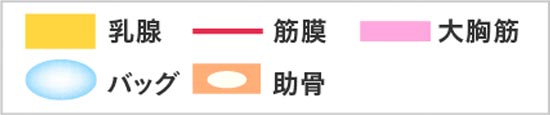 切開部位と挿入部位