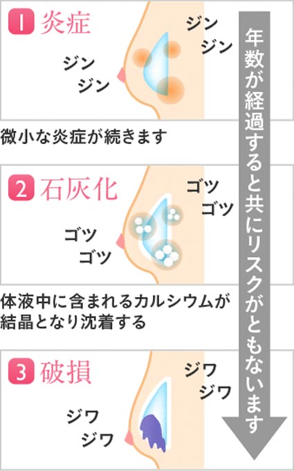 挿入年数によるリスク