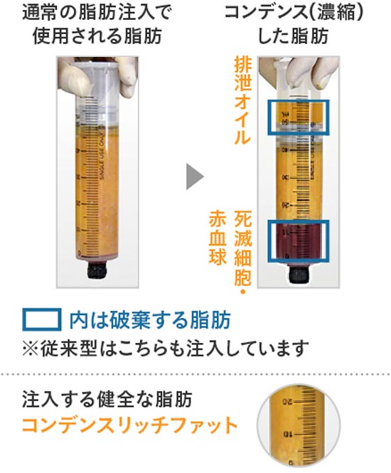 脂肪注入