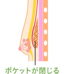 ポケットが閉じる