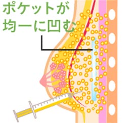 ポケットが均一に凹む