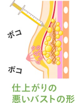 仕上がりの悪いバストの形