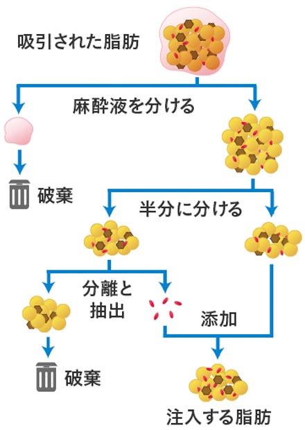 脂肪幹再脂肪注入