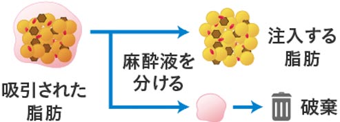 脂肪注入